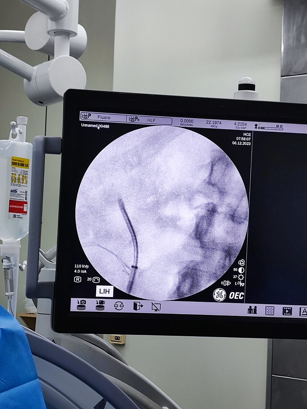 Equipamento de fluoroscopia utilizado em procedimentos urológicos